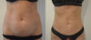 Tummy Tuck case #28307 slider thumbnail