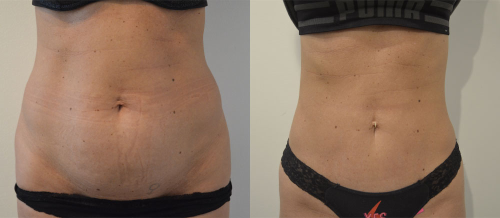 Tummy Tuck case #28307