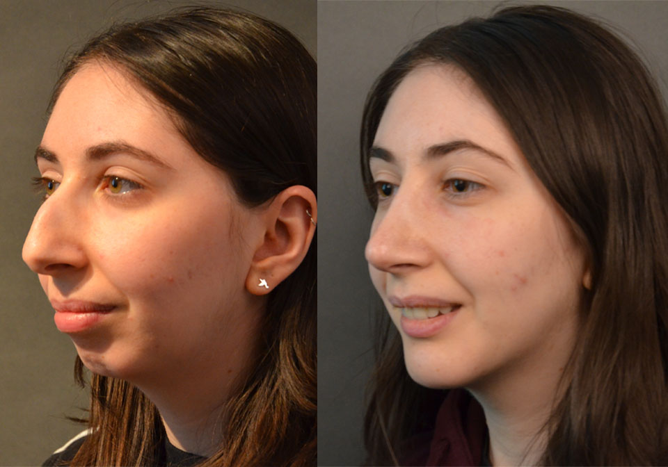 Primary Rhinoplasty case #28241