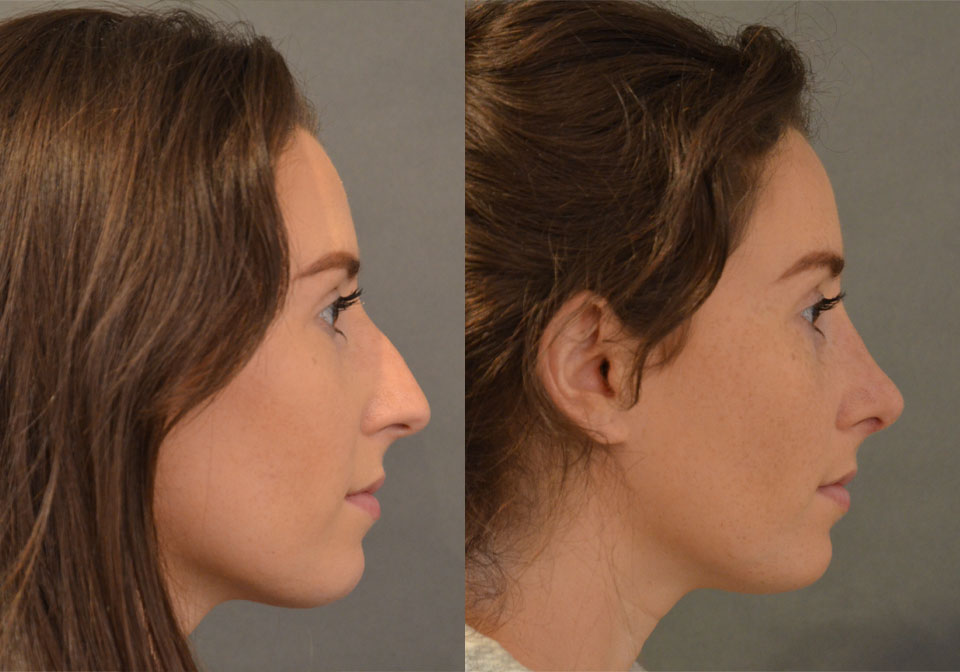 Primary Rhinoplasty case #28255