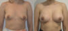 Breast Augmentation case #28318 slider thumbnail