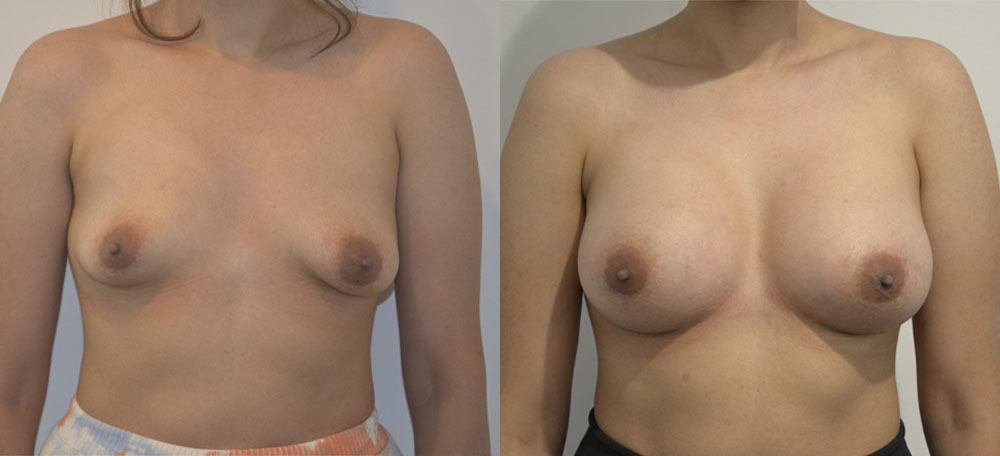 Breast Augmentation case #28318