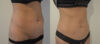 Tummy Tuck case #28307 slider thumbnail