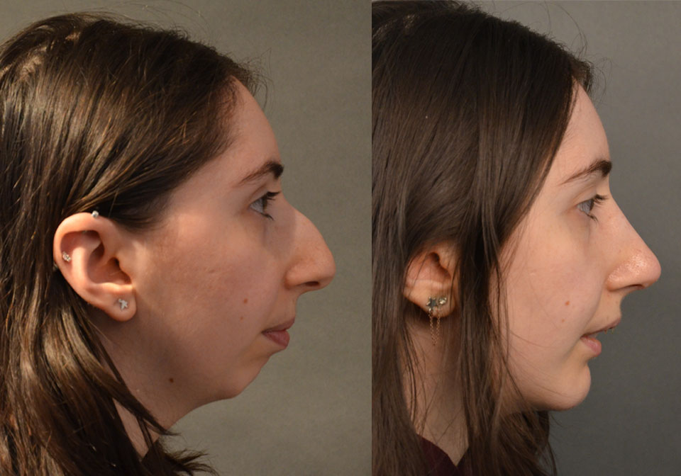 Primary Rhinoplasty case #28241