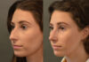 Primary Rhinoplasty case #28255 slider thumbnail