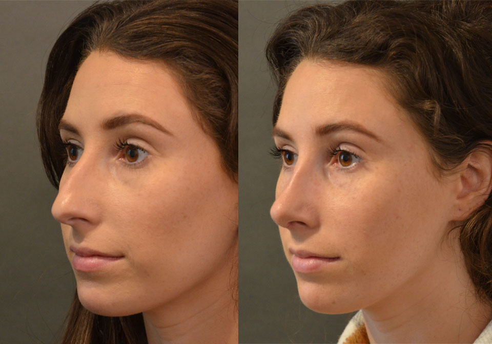 Primary Rhinoplasty case #28255