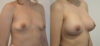 Breast Augmentation case #28318 slider thumbnail