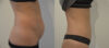 Tummy Tuck case #28307 slider thumbnail