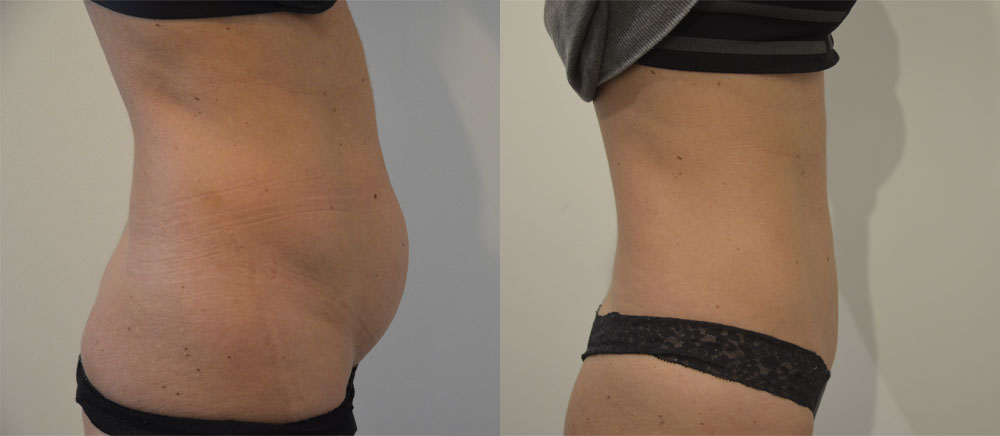 Tummy Tuck case #28307