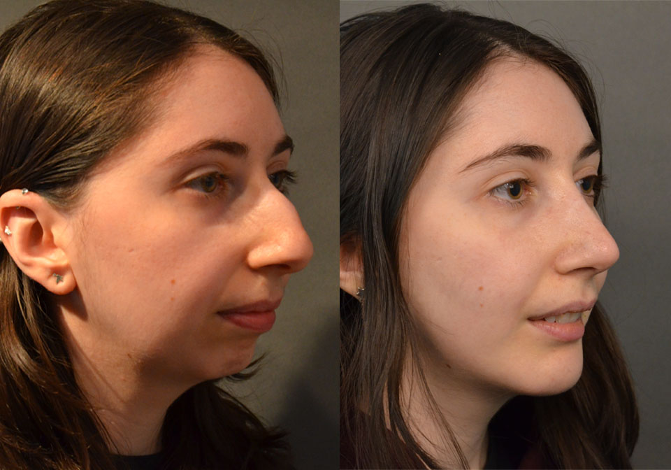 Primary Rhinoplasty case #28241