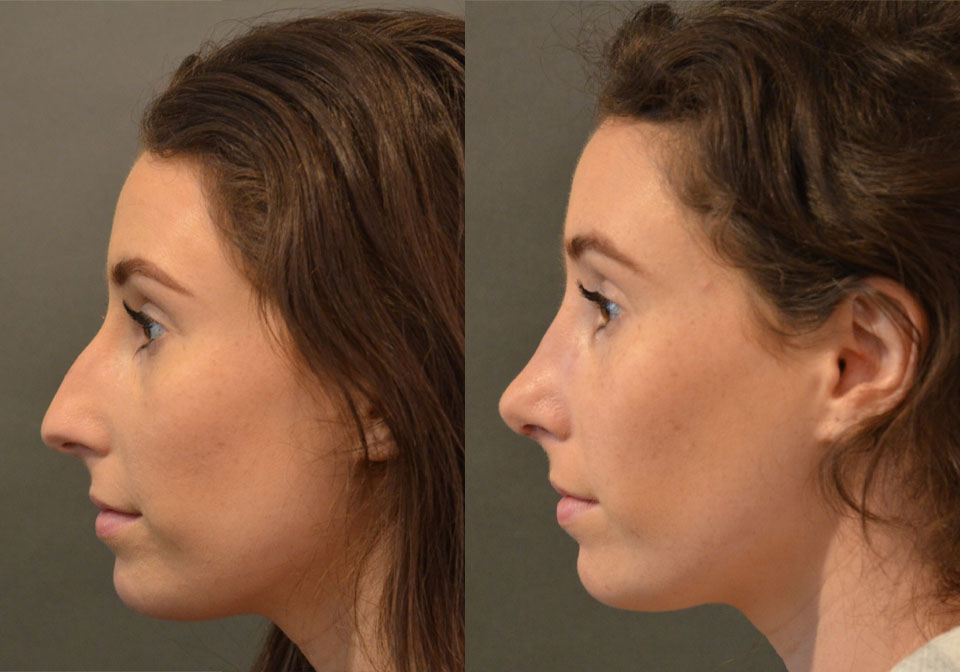 Primary Rhinoplasty case #28255