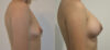 Breast Augmentation case #28318 slider thumbnail