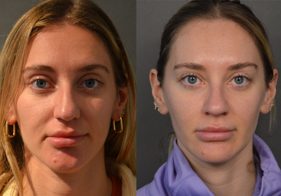 Primary Rhinoplasty case #28273