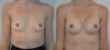 Breast Augmentation case #28322 slider thumbnail