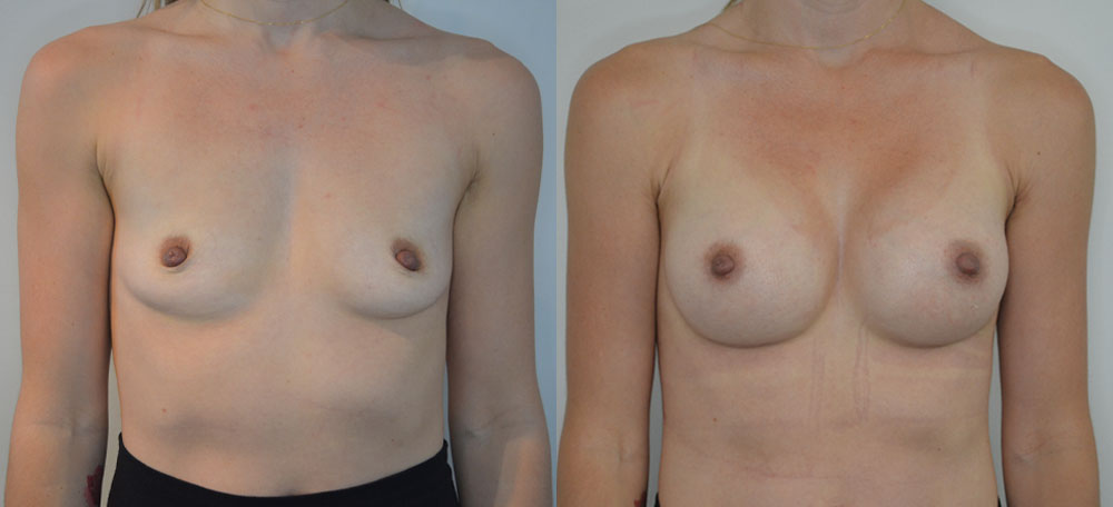 Breast Augmentation case #28322