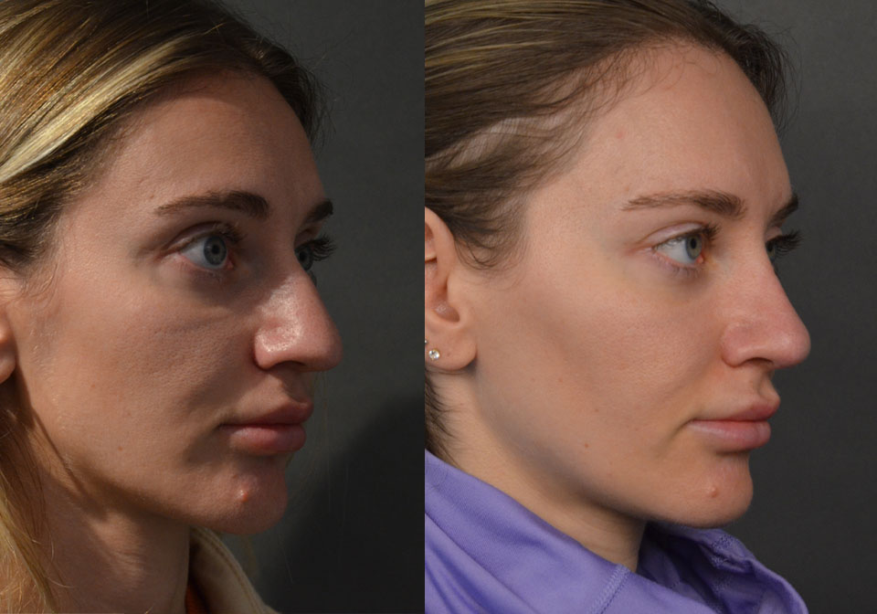 Primary Rhinoplasty case #28273