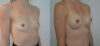 Breast Augmentation case #28322 slider thumbnail