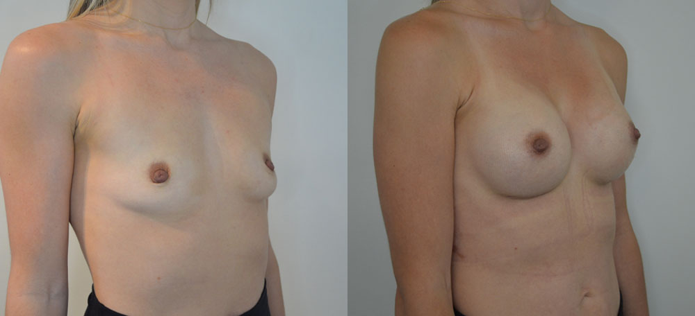 Breast Augmentation case #28322