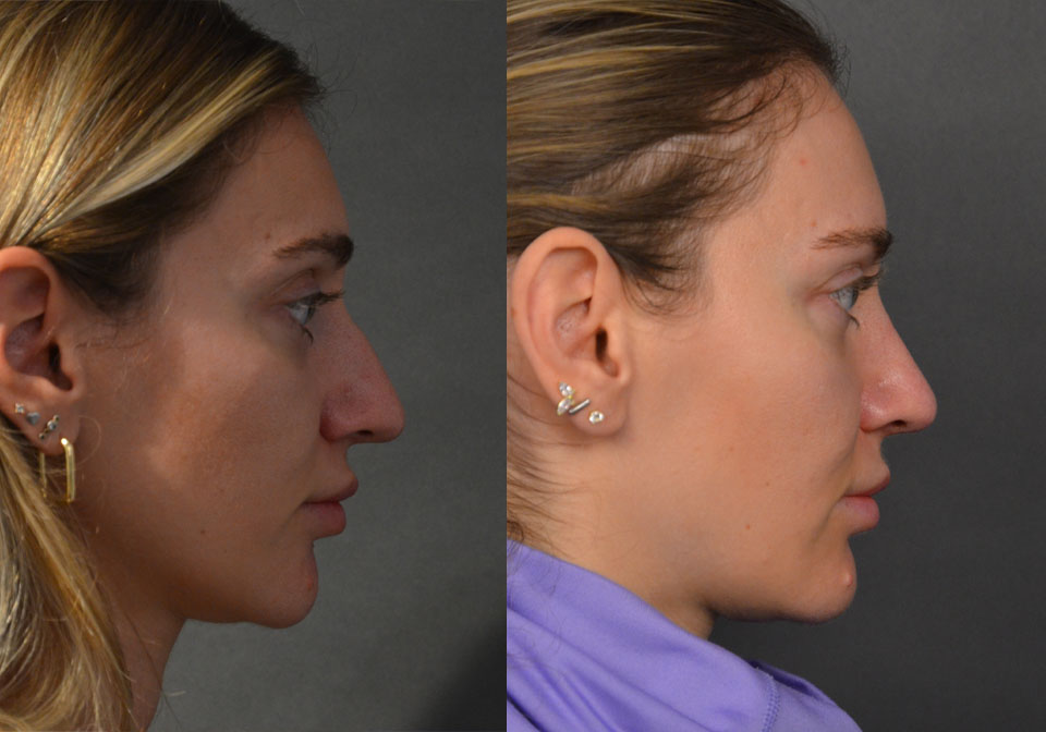 Primary Rhinoplasty case #28273