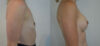 Breast Augmentation case #28322 slider thumbnail