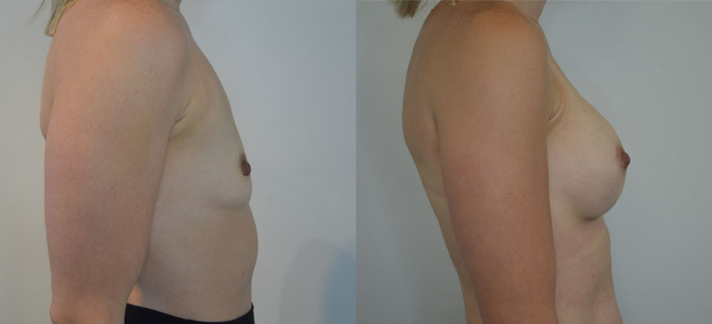 Breast Augmentation case #28322