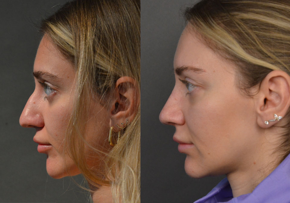 Primary Rhinoplasty case #28273