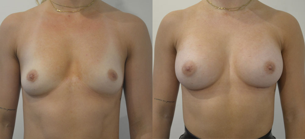 Breast Augmentation case #28326