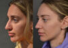 Primary Rhinoplasty case #28273 slider thumbnail