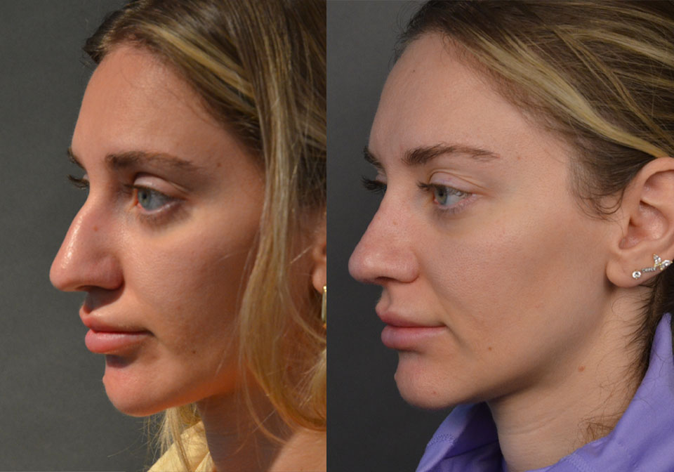 Primary Rhinoplasty case #28273