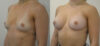 Breast Augmentation case #28326 slider thumbnail