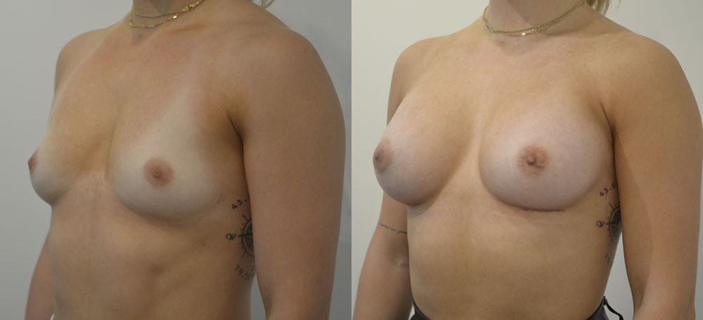 Breast Augmentation case #28326