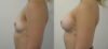 Breast Augmentation case #28326 slider thumbnail