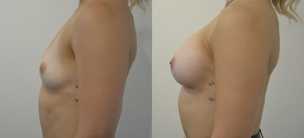 Breast Augmentation case #28326