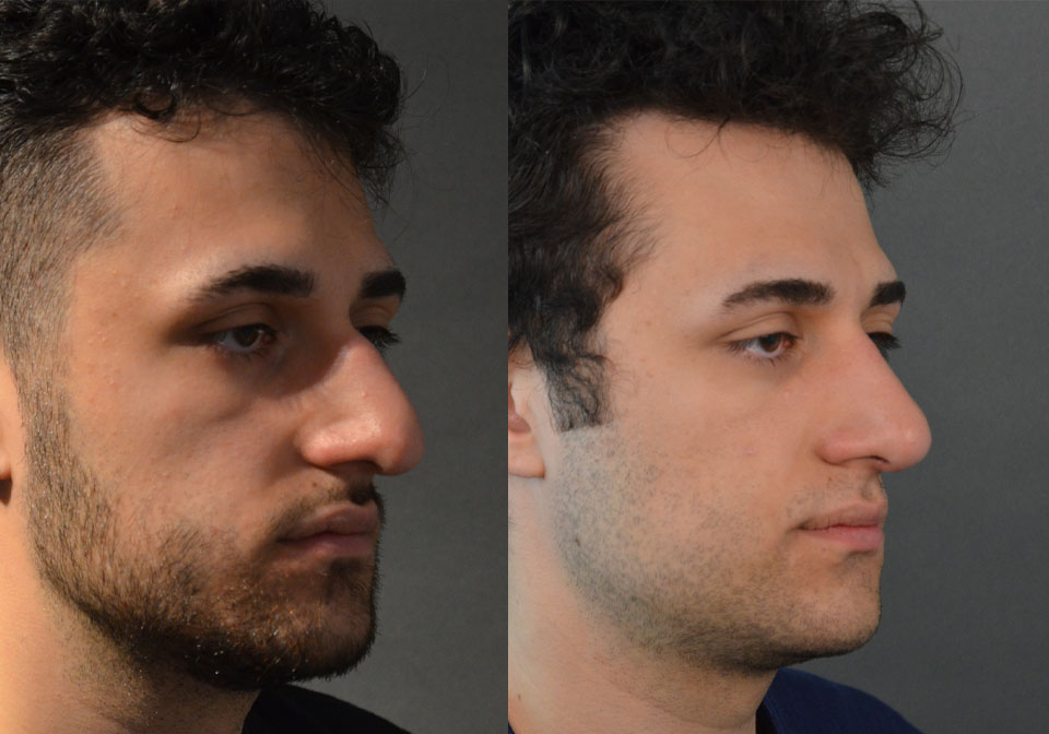 Primary Rhinoplasty case #28264