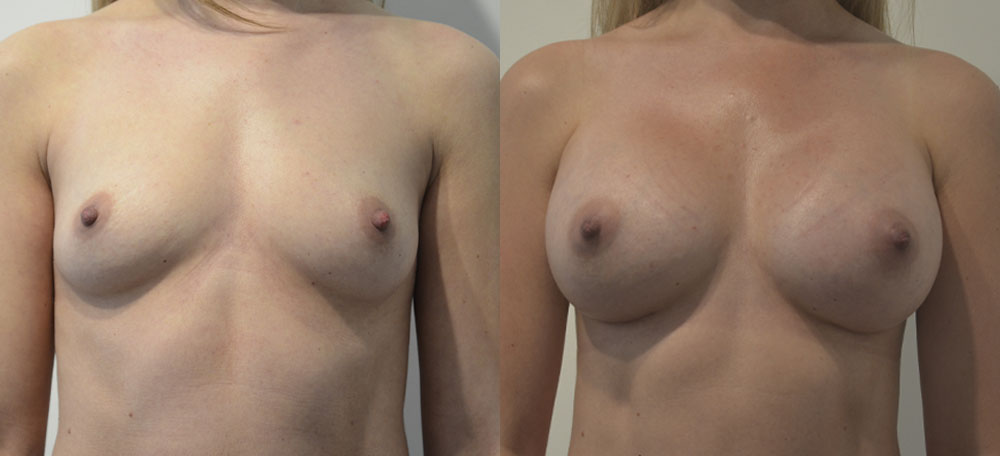 Breast Augmentation case #28330