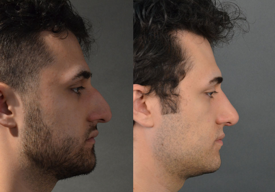 Primary Rhinoplasty case #28264