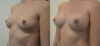 Breast Augmentation case #28330 slider thumbnail