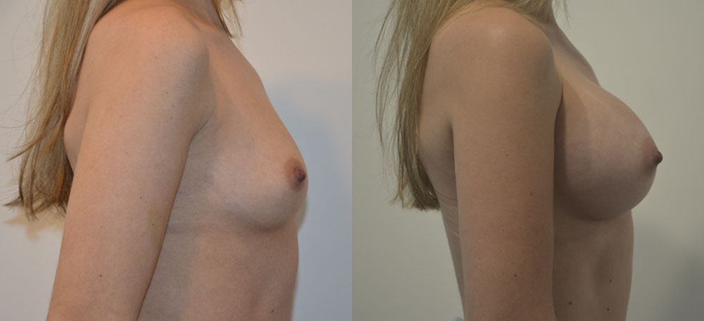 Breast Augmentation case #28330