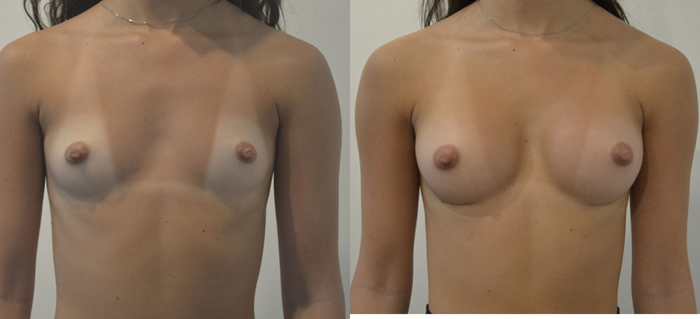 Breast Augmentation case #28334