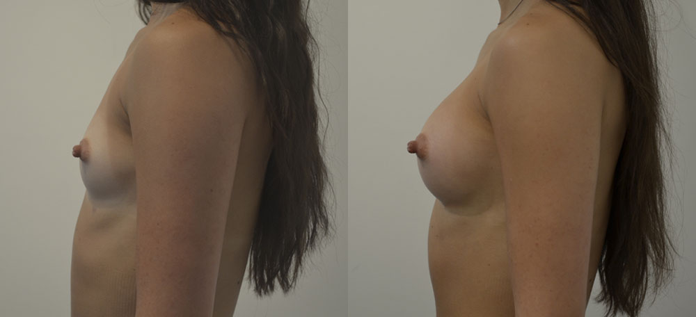 Breast Augmentation case #28334