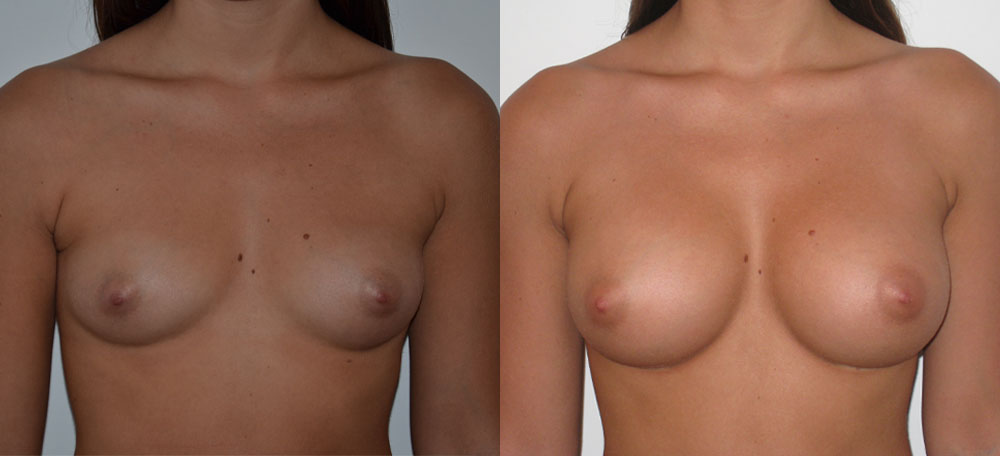 Breast Augmentation case #28338