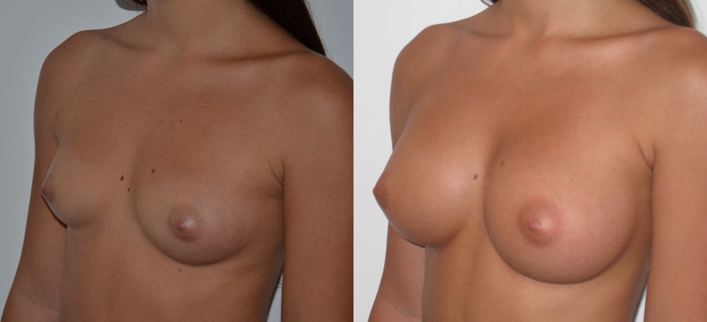 Breast Augmentation case #28338