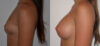 Breast Augmentation case #28338 slider thumbnail