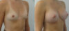 Breast Augmentation case #28342 slider thumbnail