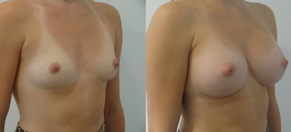 Breast Augmentation case #28342