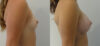 Breast Augmentation case #28342 slider thumbnail