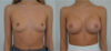 Breast Augmentation case #30805 slider thumbnail