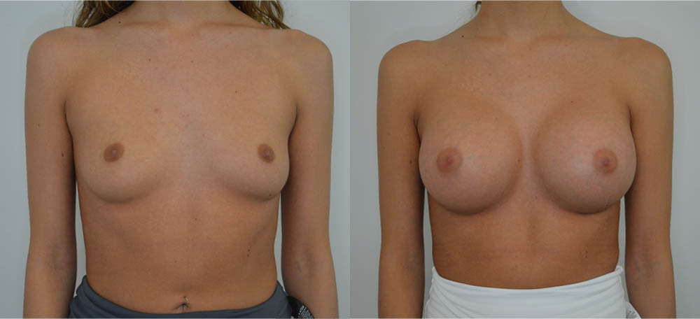 Breast Augmentation case #30805