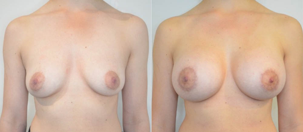 Breast Lift case #30786