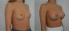 Breast Augmentation case #30805 slider thumbnail